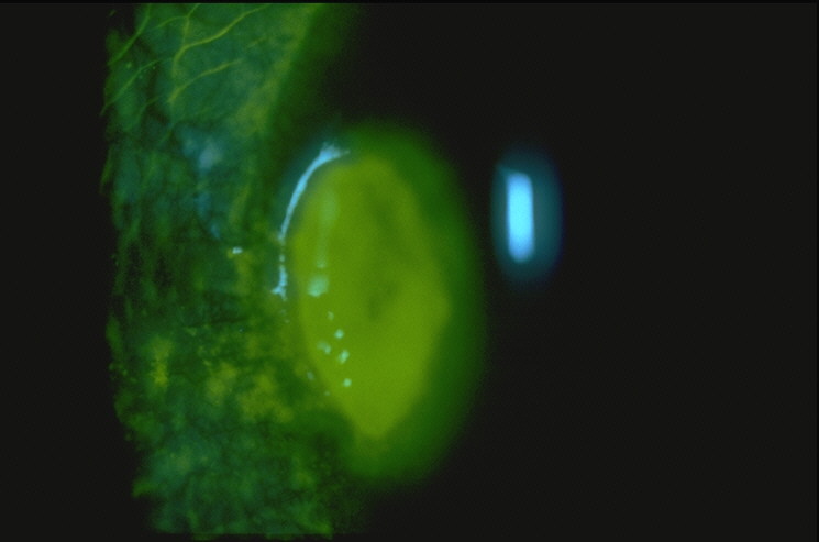 fluorescein stain
